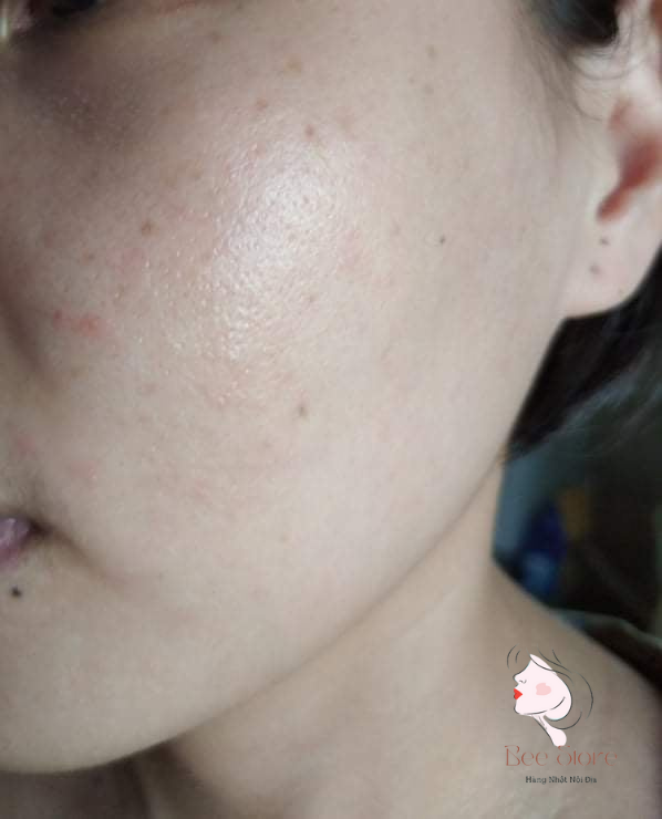 tình trạng da trước khi treatment