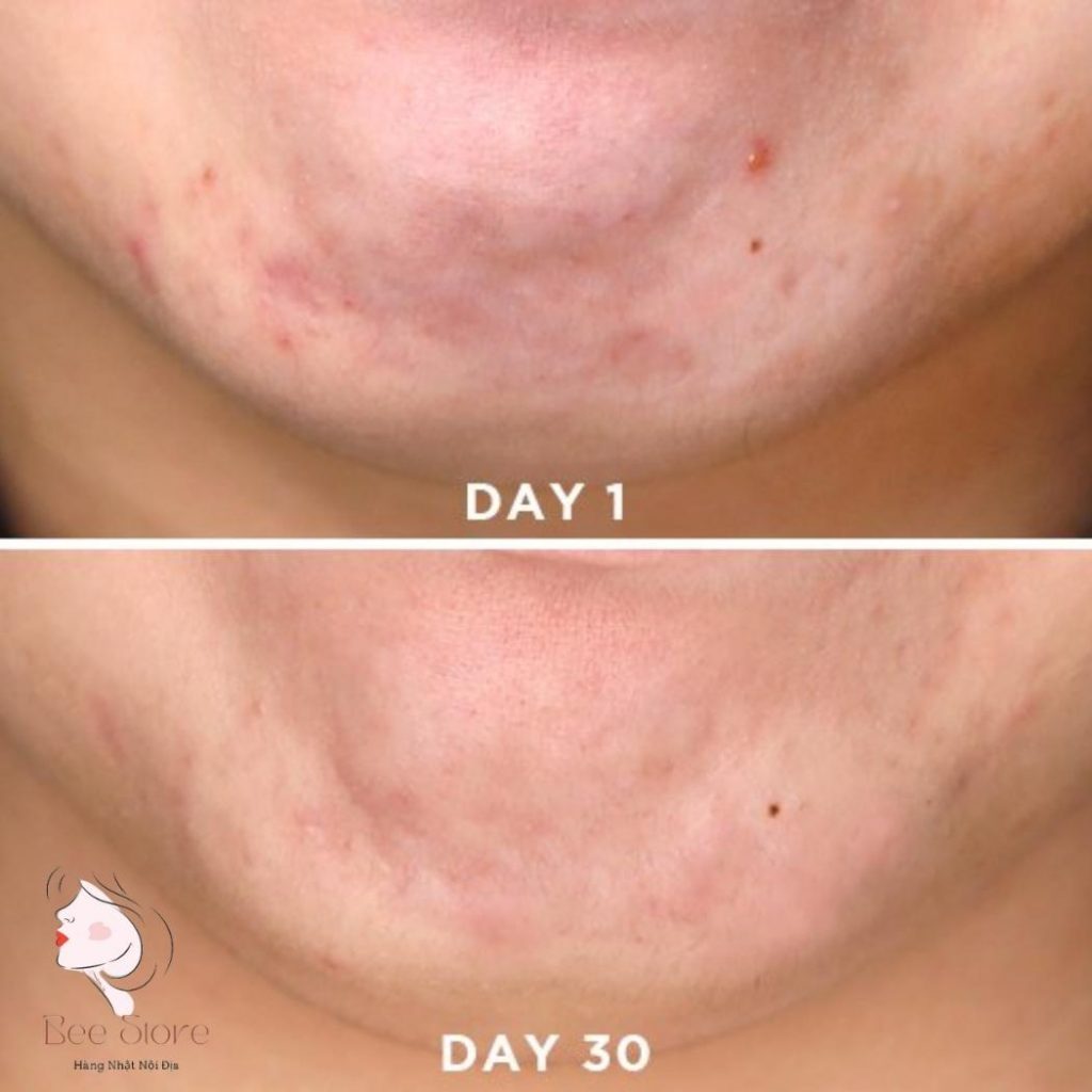 niacinamide giúp giảm thâm mụn