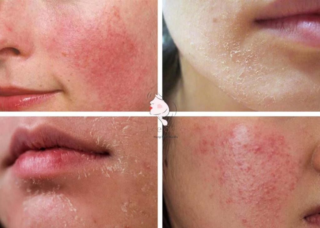 tác dụng phụ của tretinoin
