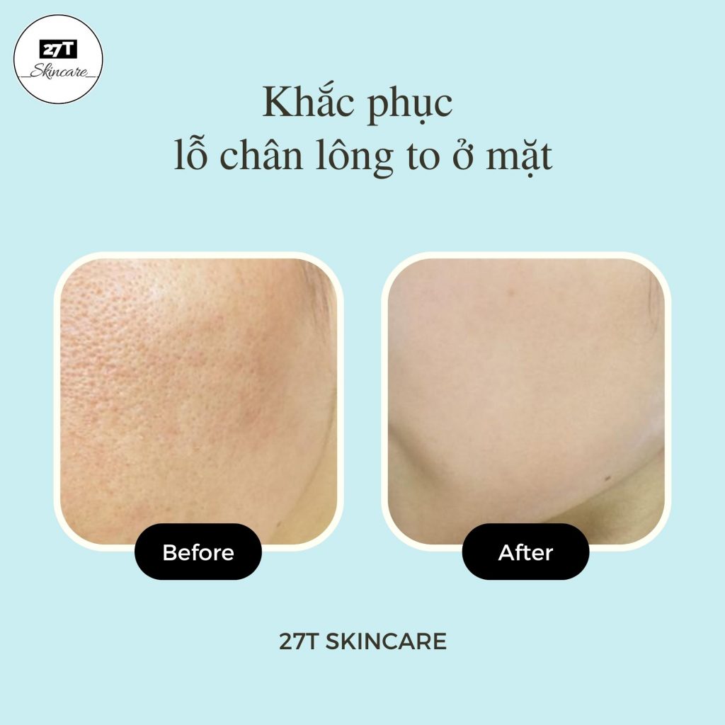 khắc phục lỗ chân lông to ở mặt