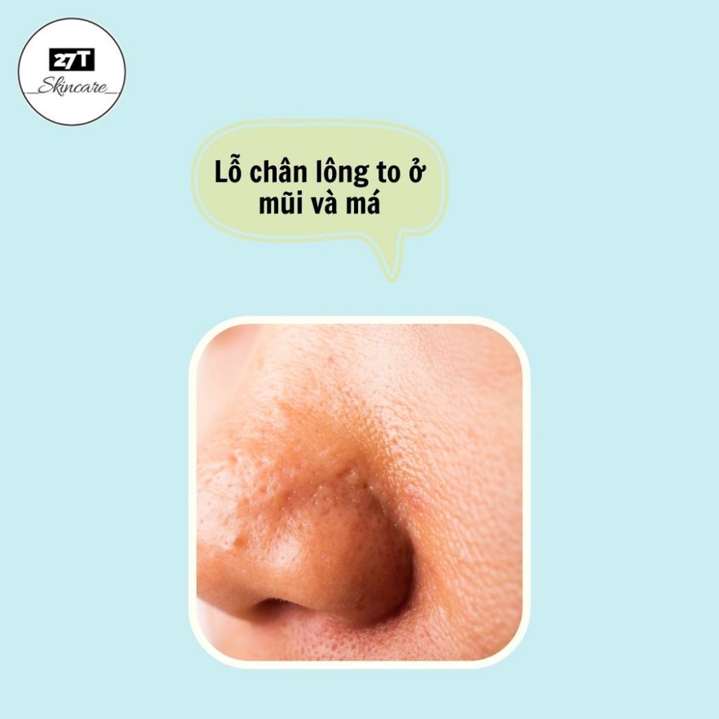 lỗ chân lông to ở mũi và má