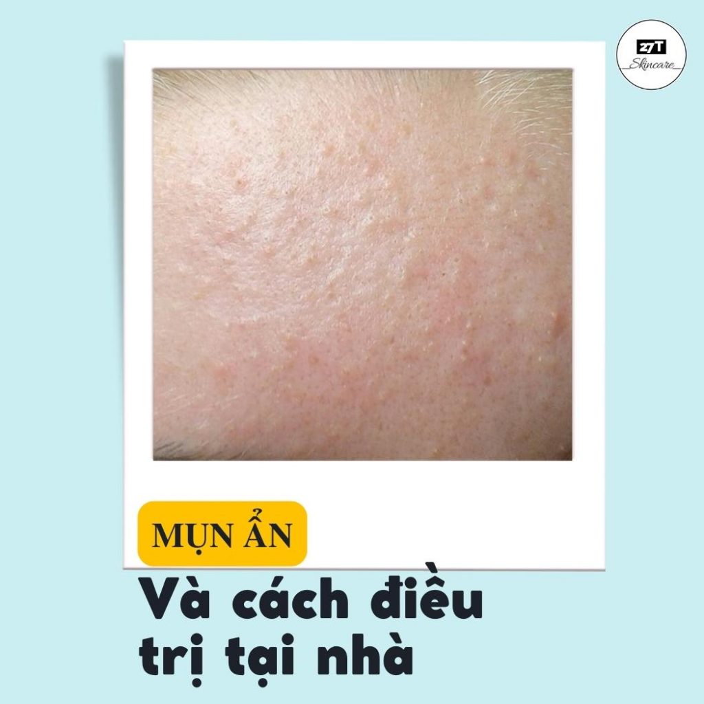 mụn ẩn và cách điều trị