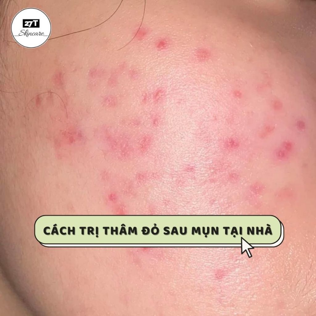 cách trị thâm đỏ sau mụn tại nhà