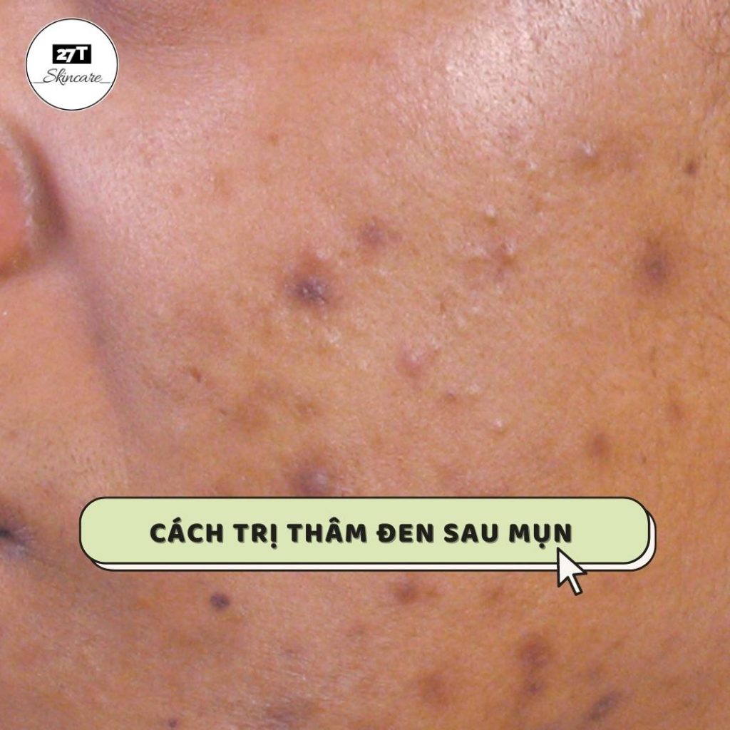 trị thâm đen sau mụn